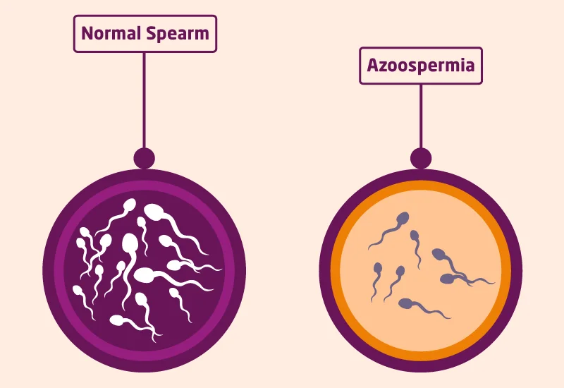 Azoospermia Treatment