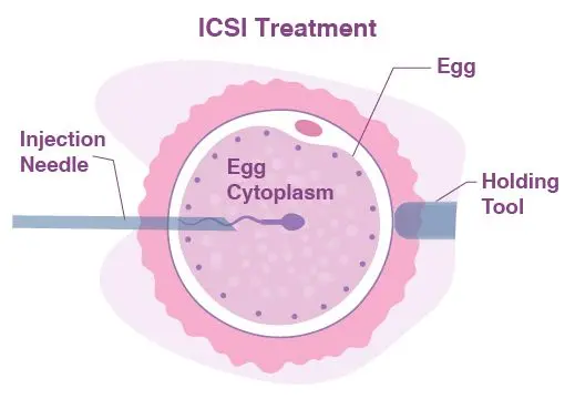 ICSI Procedure